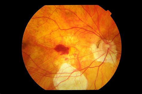 Myopic Degeneration — STRATHFIELD RETINA CLINIC