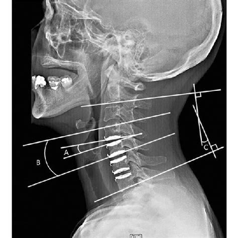 (PDF) Surgical Outcome of Cervical Arthroplasty Using Bryan®