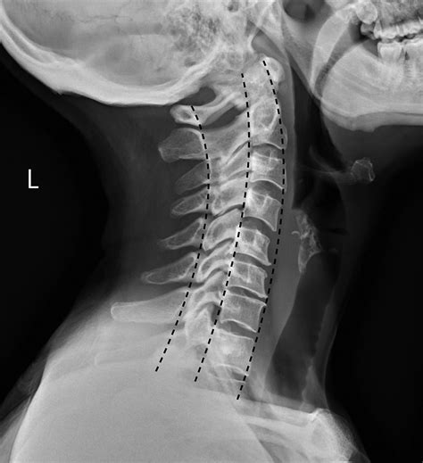 Cervical spine radiology - Anaesthesia & Intensive Care Medicine