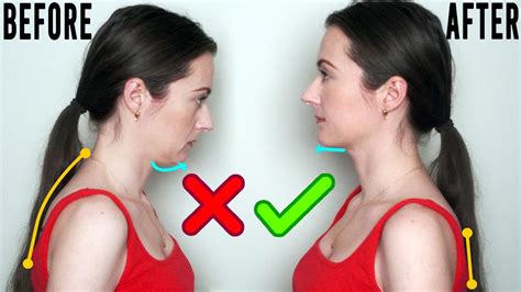 Mewing before and after | 2+ Years of tongue posture exercises - YouTube