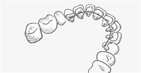 Lingual Braces Pros and Cons | Lingual Braces Disadvantages | Sensu