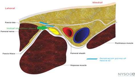 Femoral Nerve Block Quadriceps Tendon Rupture - vrogue.co