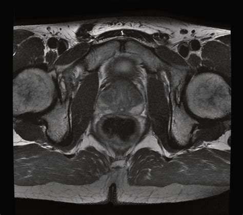 Prostate MRI - Insight Medical Imaging