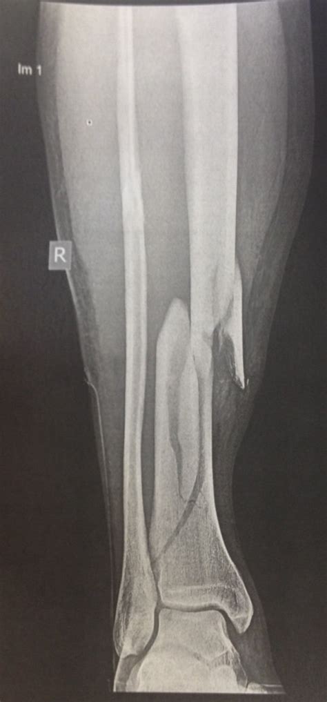 Management of a complex tib-fib fracture after delayed union - any thoughts?