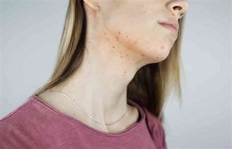 7 Ways To Get Rid Of Pitted Acne Scars | Causes And Types