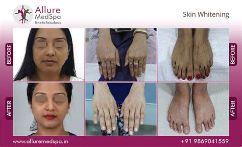 Skin Whitening Treatment, Skin Lightening Cost in Mumbai, India