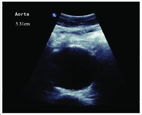 Ultrasound scan of the aorta 3 months prior to admission showing a 5.3 ...