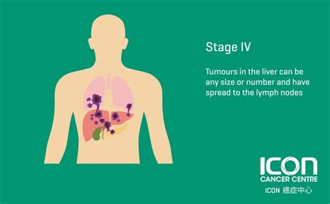 Liver Cancer — Icon Cancer Centre Hong Kong