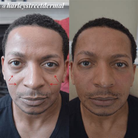 Cheek Fillers for Men of All Ages | Harley Street Dermal