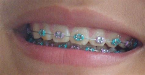 Purple and turquoise! | Braces | Pinterest | Turquoise and Purple