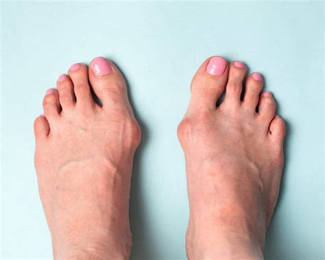 How to Get Rid of a Bunion (Hallux Valgus) | Liebscher & Bracht