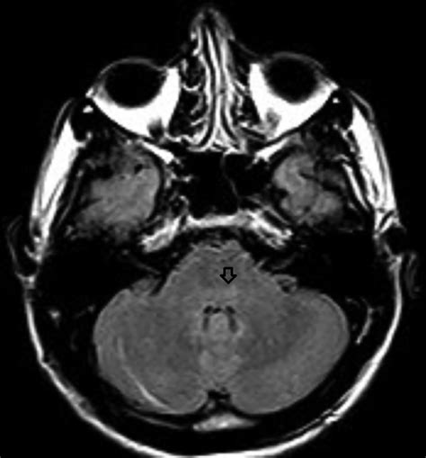 Rabies Encephalitis • APPLIED RADIOLOGY