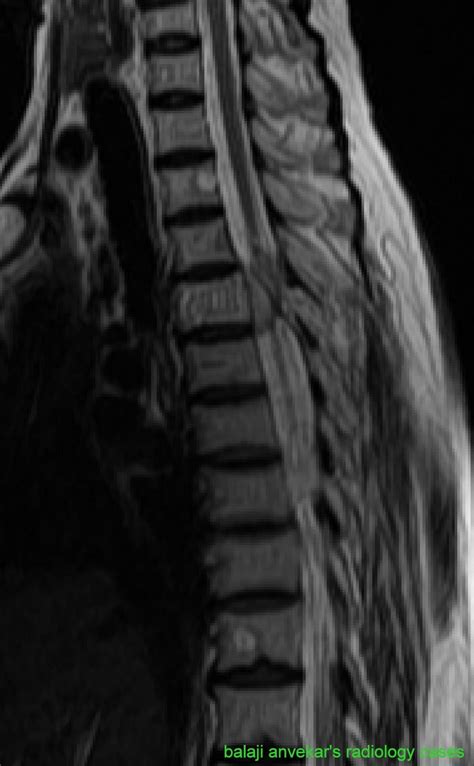 VERTEBRAL BODY HEMANGIOMA MRI RADIOLOGY - Wroc?awski Informator Internetowy - Wroc?aw, Wroclaw ...