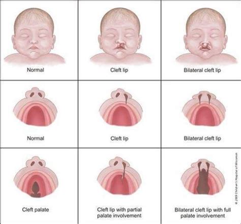 Types of cleft palate | Cleft lip and palate, Pediatric nursing, Cleft lip