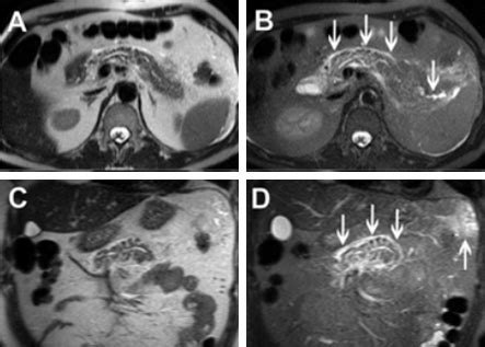 MRI Pancreas - Los Angeles, CA | Cedars-Sinai