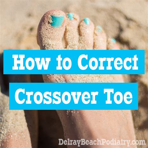 How is crossover toe corrected? - Delray Beach Podiatry