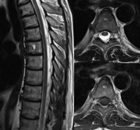 MRI of the thoracic spine after removal of the knife showing normal ...