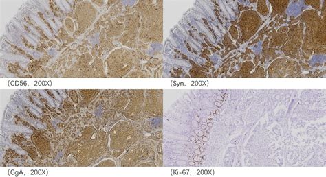 Case report: Coexistence of sigmoid tumor with unusual pathological ...