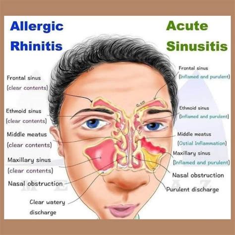 Allergic vs Acute rhinitis | Sinusitis, Nasal obstruction, Maxillary sinus