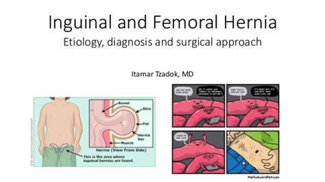 Inguinal Hernia Musculoskeletal Key