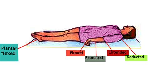 Neuroanatomy, Decerebrate Rigidity - StatPearls - NCBI Bookshelf