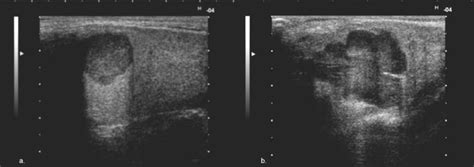 Grayscale ultrasound: Pleomorphic adenoma – types of contour; a) Small ...