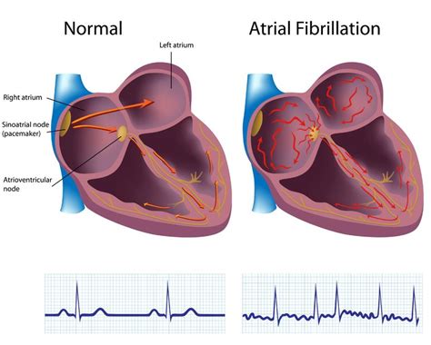 Atrial Fibrillation | Causes, Symptoms, Diagnosis, Treatment