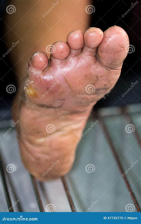 Wound of diabetic foot stock image. Image of distress - 47735775