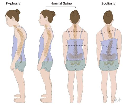 Kyphosis/Scoliosis - Goodman Campbell