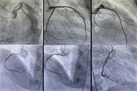 Coronary Angiography | Naples Cardiac & Endovascular Center