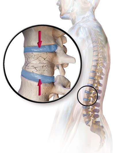 Cyphoplastie : Réparation de fractures vertébrales par compression par vertébroplastie ...