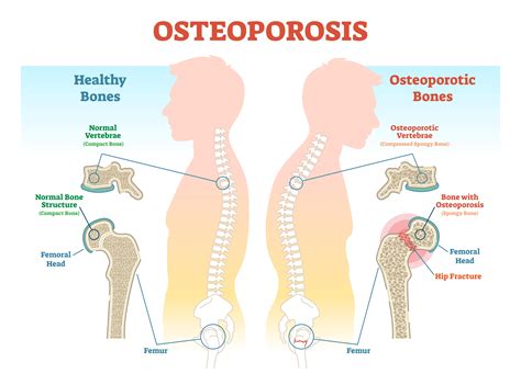 Can Osteoporosis Be Reversed? The Truth About Bone Loss