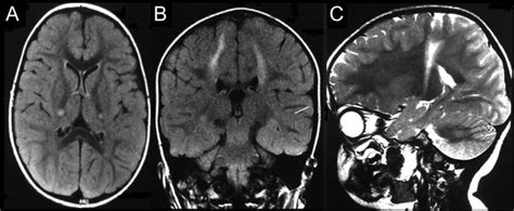 Krabbe Disease - Causes, Symptoms, Life Expectancy, MRI, Treatment