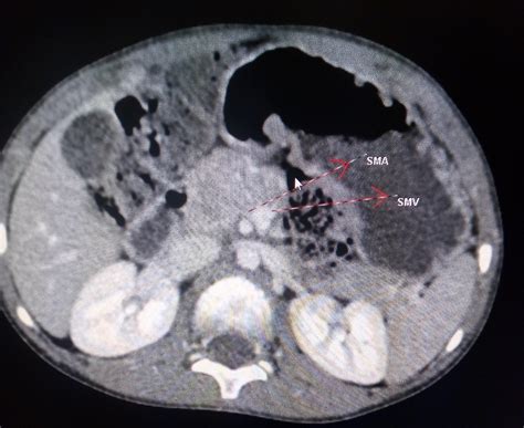 Midgut Volvulus CT - Sumer's Radiology Blog