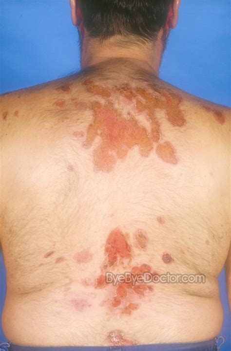 Pemphigus Vulgaris – Pictures, Symptoms, Causes and Treatment