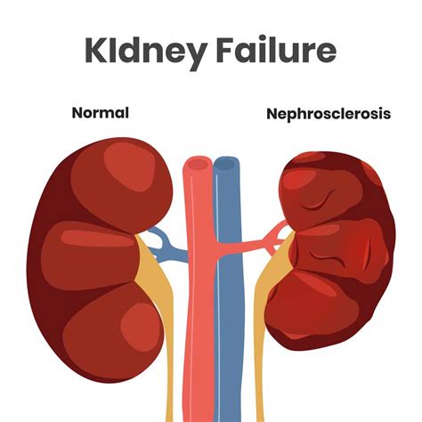 Is Renal Failure Kidney Disease - HealthyKidneyClub.com