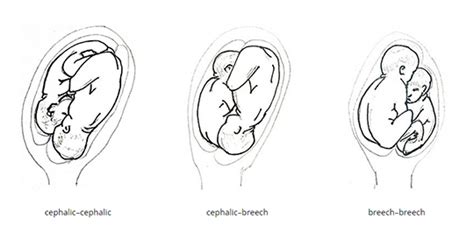 Delivery of Twins | Article | GLOWM