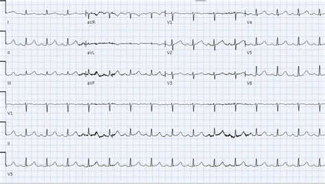 Look Beyond Syncope: A Positive Outcome in the Management of Multiple ...