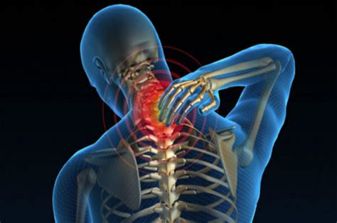 Acute Wry Neck: A Cause Of Neck Pain - Newquay Physiotherapy