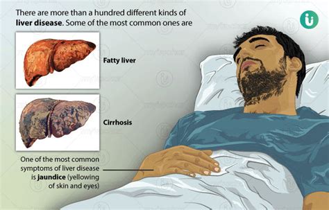 Liver Cirrhosis Meaning In Hindi - Rima1