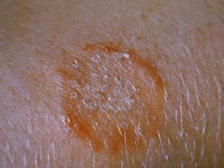 Peeling Skin: Causes, Symptoms, Diagnosis And Treatment - Boldsky.com