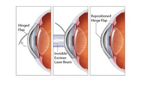 Refractive Surgery in Delhi | Best Eye Specialist - Dr Anisha Gupta