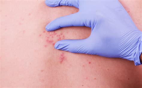 10 Symptoms of Shingles - Healthversed