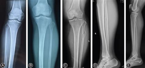 Manifestations of proximal fibular fractures. (A) Fibular neck... | Download Scientific Diagram