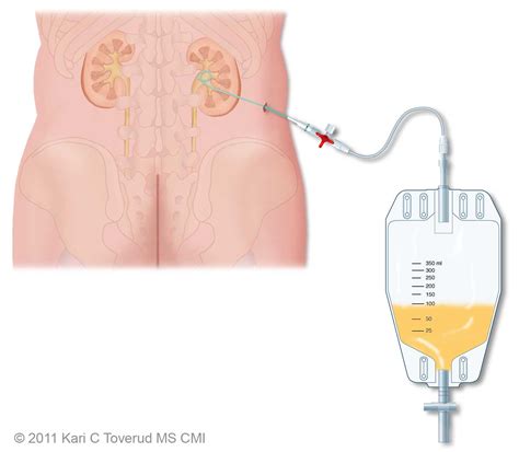 Nephrostomy - InsideRadiology