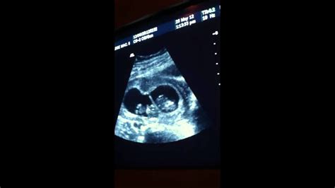 Twins 10 week ultrasound - YouTube