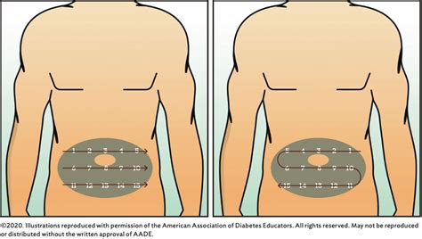 Insulin Injection Sites, Im Injection Sites, Nursing Notes, 56% OFF