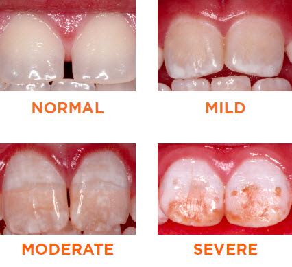 Fluorosis Facts: Information Parents & Caregivers - HealthyChildren.org