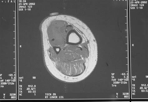 Synovial Sarcoma: Soft Tissue Sarcoma