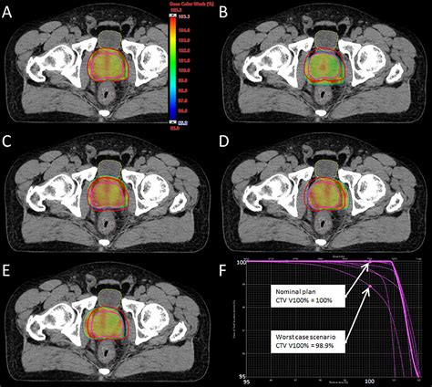 Characterization of Photon Intensity Modulated Radiation Therapy Robustness in Patients With ...